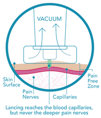 A diagram of how the Genteel Lancing Device uses vacuum suction to make lancing pain free